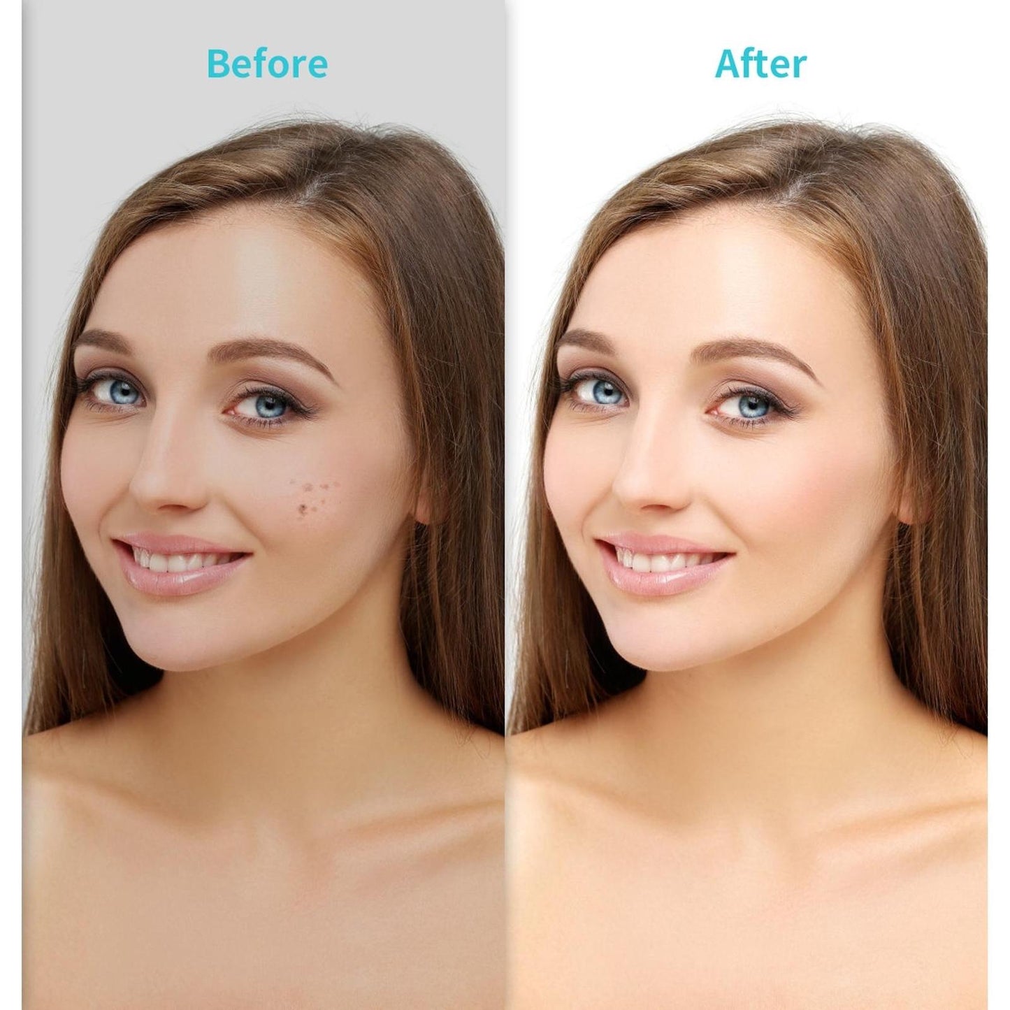 6 Speed - Anti Aging Laser Plasma Pen - Mole, Spot, Wart, Tatoo Removal - New!