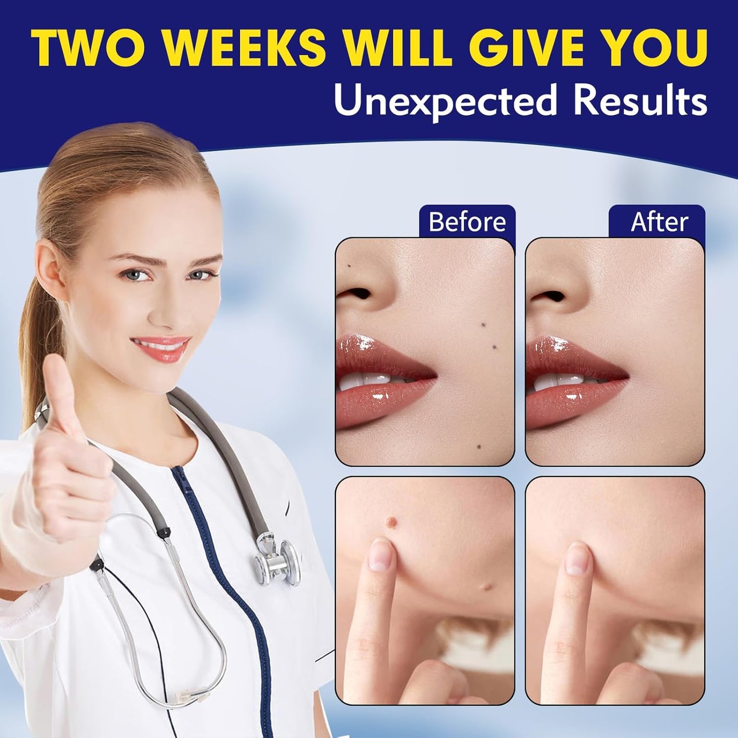 Bighero Liquid Wart, Corn, & Callus Remover (2 Pack, 2 oz total) Exp. 11/26