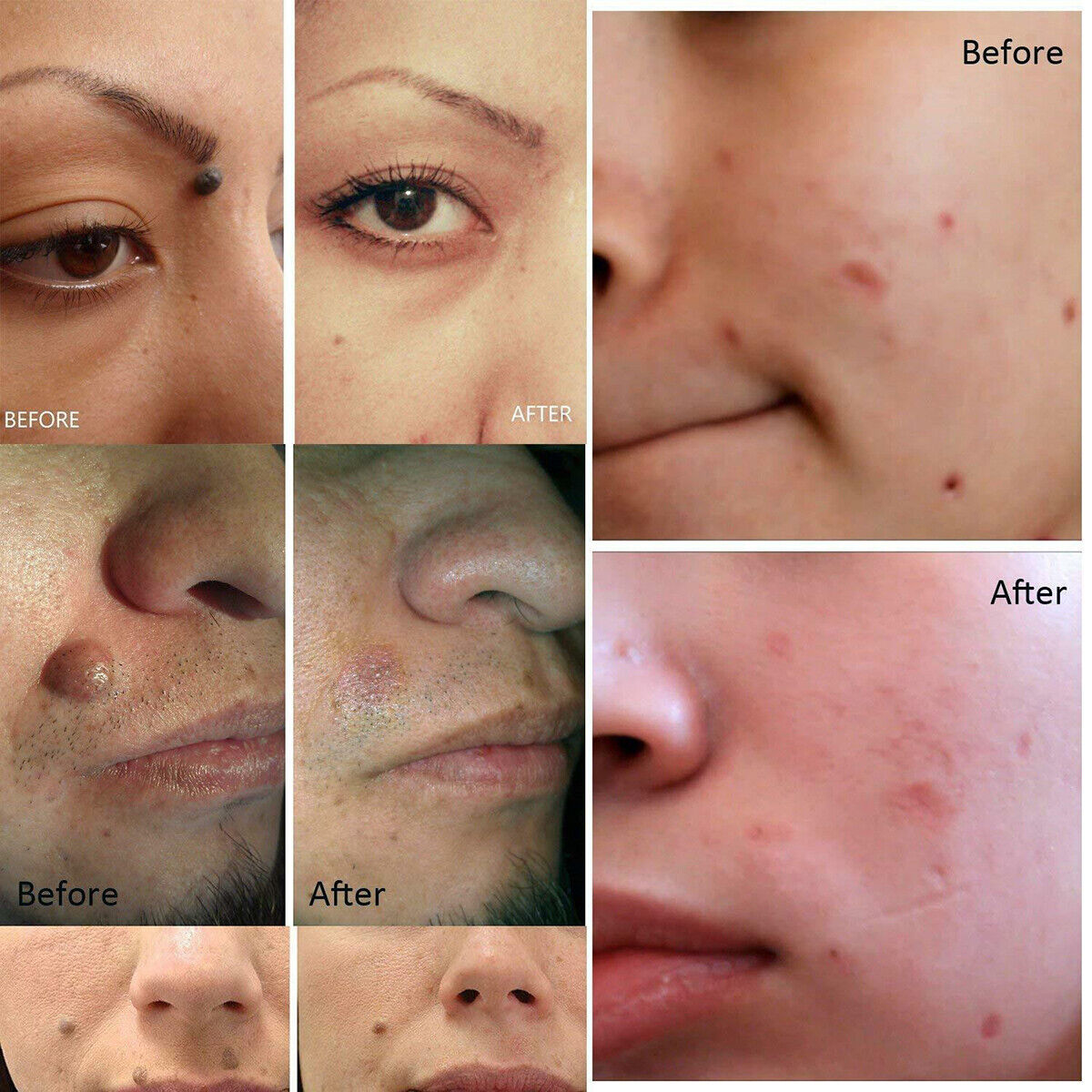 Anti Aging Laser Plasma Pen, 6 Speed Nevus- Mole, Spot, Wart, Tag, Tatoo Removal - New!