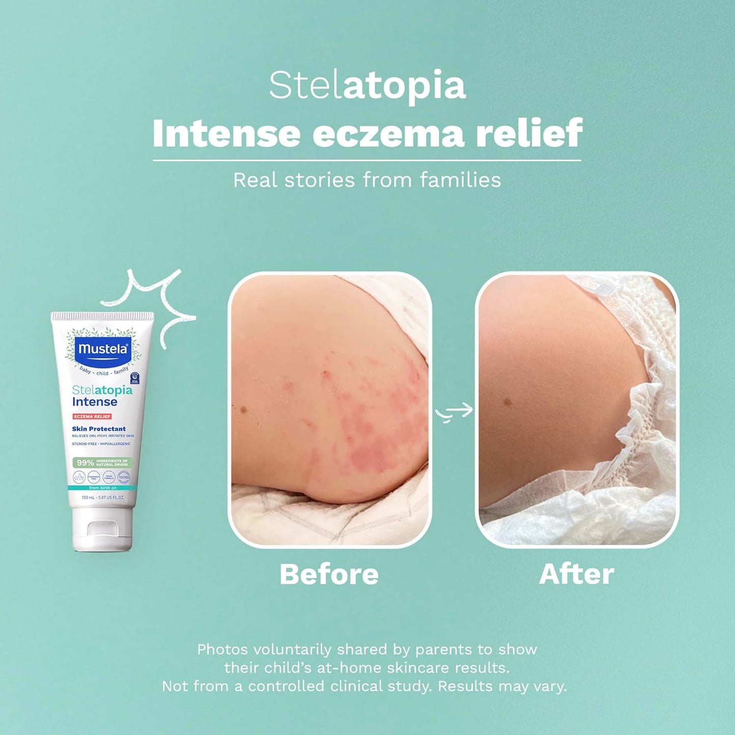 Mustela Eczema Relief Cream Stelatopia Intense, 5.07 fl oz, Frag-Free, Exp 7/27