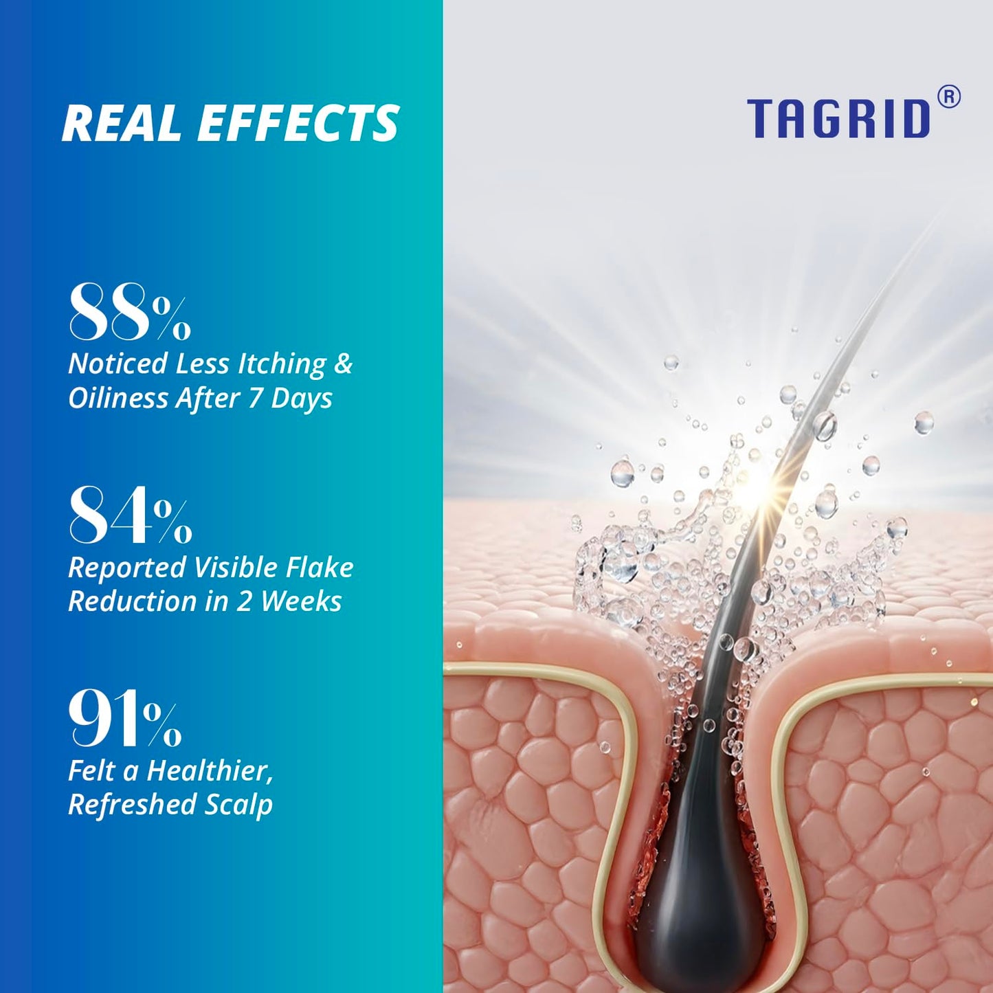 TAGRID Anti-Fungal Shampoo, Scalp Treatment - Relieves Itching, 10 oz, Exp. 6/27